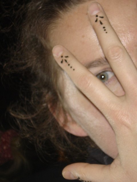 Chalazion-2